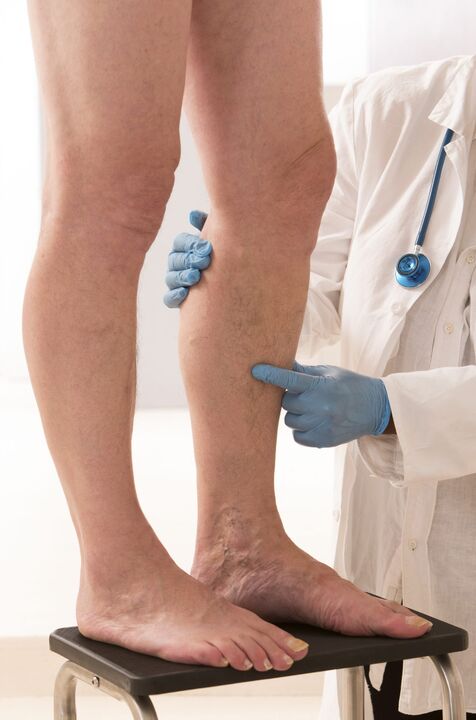Varicosis mi ez